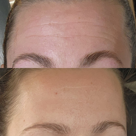 Fibroblast Forehead Treatment